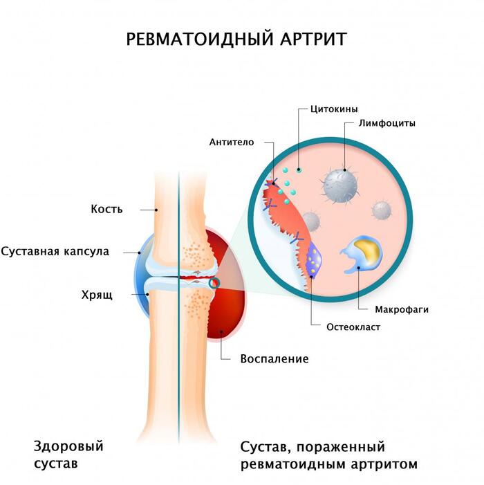 Основная характеристика ревматоидного артрита Ревматоидный артрит