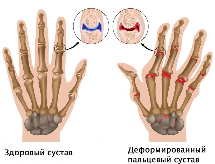 Здоровые суставы vs суставы, пораженные ревматоидным артритом Сравнение суставов здорового и больного человека